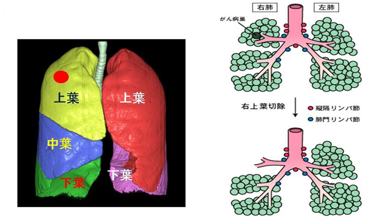 肺葉切除＋リンパ節郭清術の説明図
