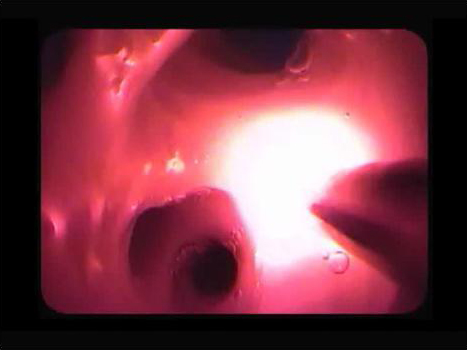 低出力レーザーと腫瘍に蓄積する光感受性物質との反応を示した写真